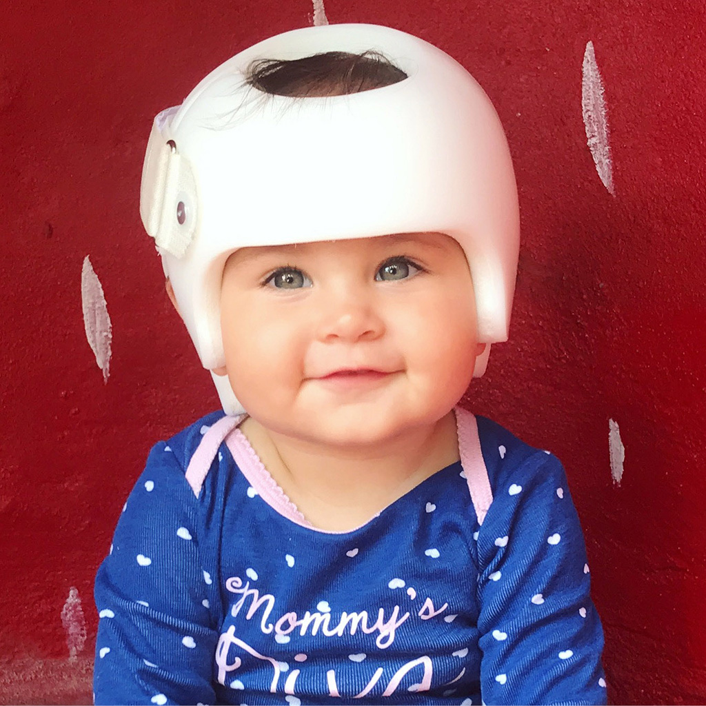 Happy Little Girl StarBand Helmet - Ortho Design cranial remolding orthosis