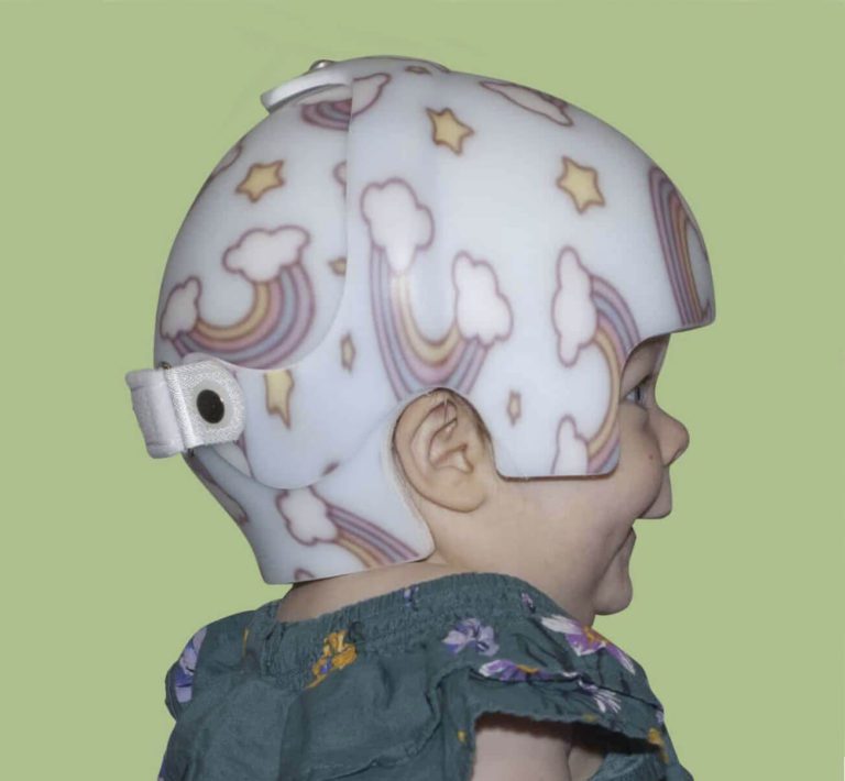 STARband Design Types - Cranial Remolding Orthosis by Ortho Design