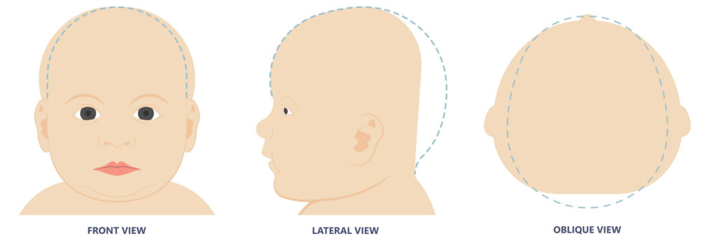 Brachycephaly - Atypical Head Shapes Infants