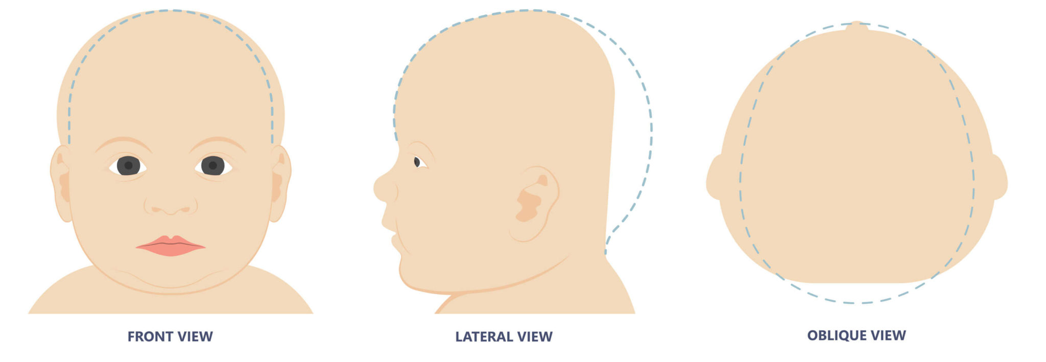 Atypical Head Shapes In Infants - Cranial Remolding Orthosis by Ortho ...