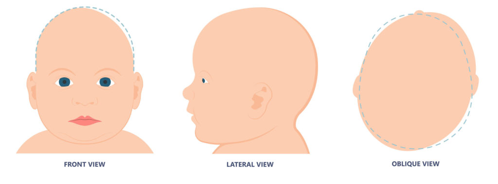 Plagiocephaly - Atypical Head Shapes Infants