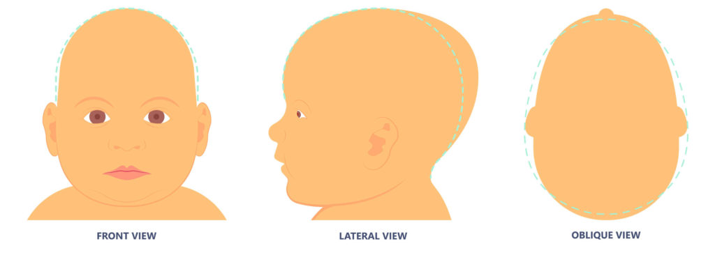 Scaphocephaly - Atypical Head Shapes Infants