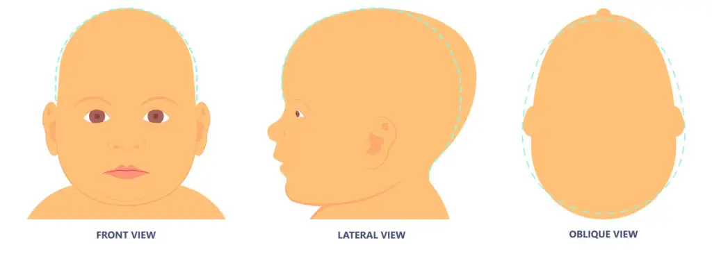 Scaphocephaly - Atypical Head Shapes Infants