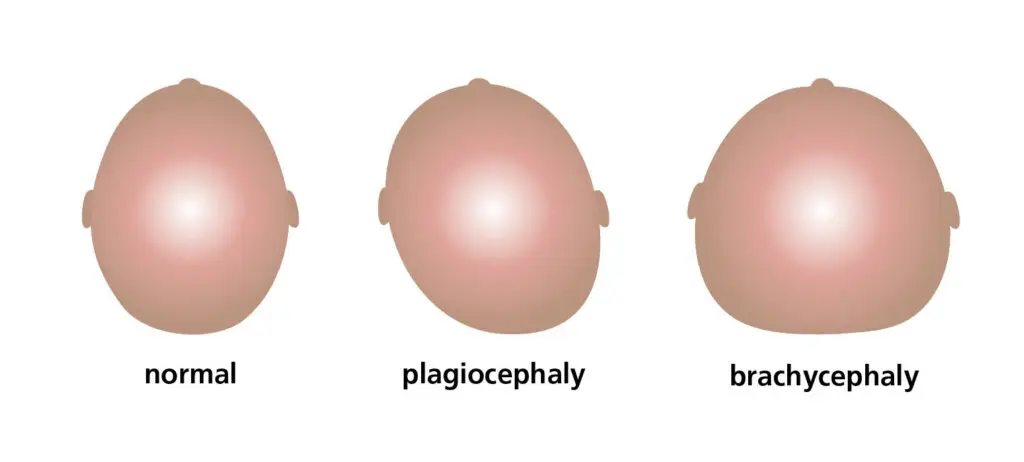 Plagiocephaly & Brachycephaly illustration